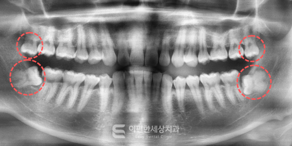 화곡역 사랑니 발치 치과 꼭 대학병원이 아니라도 가능합니다 관련 이미지 1