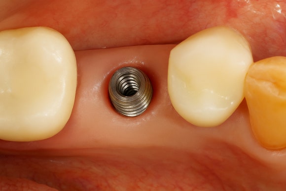임플란트 전자담배, 언제부터 필수 있을까? 관련 이미지 3
