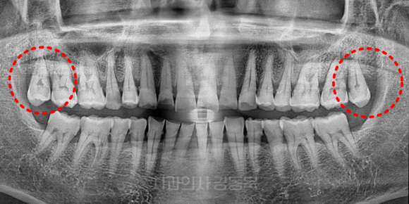가양동사랑니 처음 뽑는다면? 유형별로 쉽게 이해해 보기 관련 이미지 6