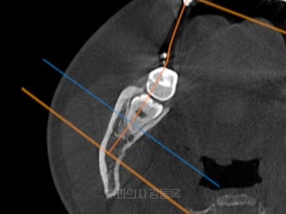 가양동사랑니 처음 뽑는다면? 유형별로 쉽게 이해해 보기 관련 이미지 5