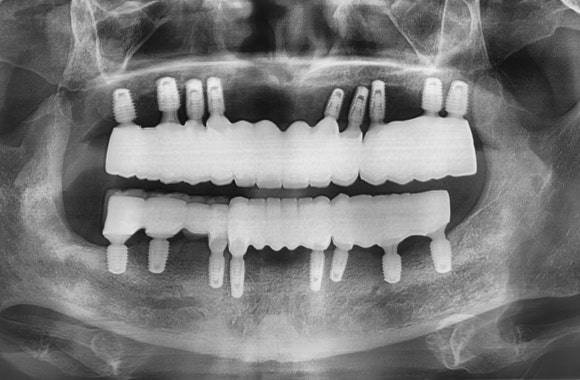 서울강서구임플란트, 고령 환자라면 꼭 확인해야 할 내용 관련 이미지 2