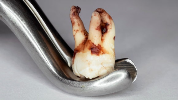 화곡사랑니, 빨리 뽑아야 이득인 이유 관련 이미지 1