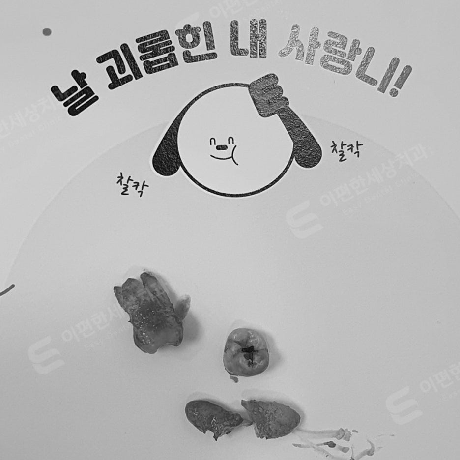 사랑니 발치 치과, 찾는 분들 읽어보세요. 관련 이미지 8