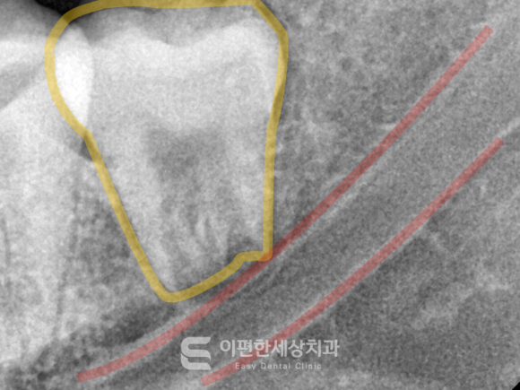 사랑니 엑스레이 CT, 촬영하는 이유는?(강서구화곡동사랑니) 관련 이미지 2