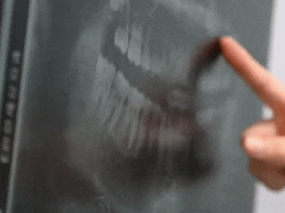 Gangseo Implants: A Pre-Treatment Checklist Based on Clinical Experience image 5