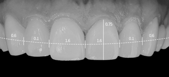 강서구 라미네이트 치과, 시술 전 후회하지 않으려면 꼭 확인하세요 관련 이미지 7