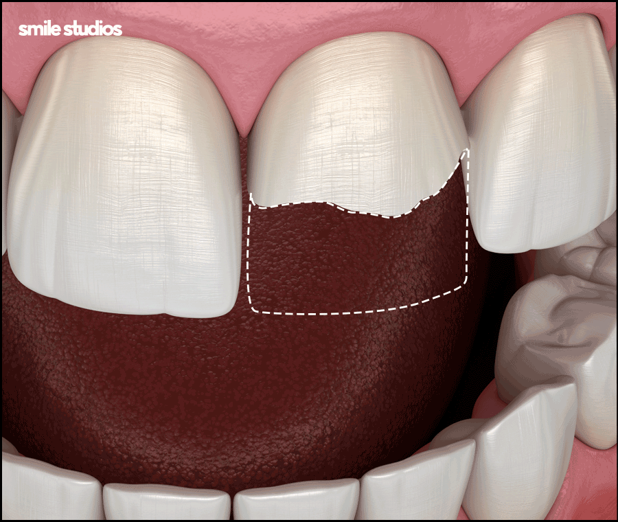 앞니 크랙 금간 치아, 빠른 수복 방법 알아보기 관련 이미지 3