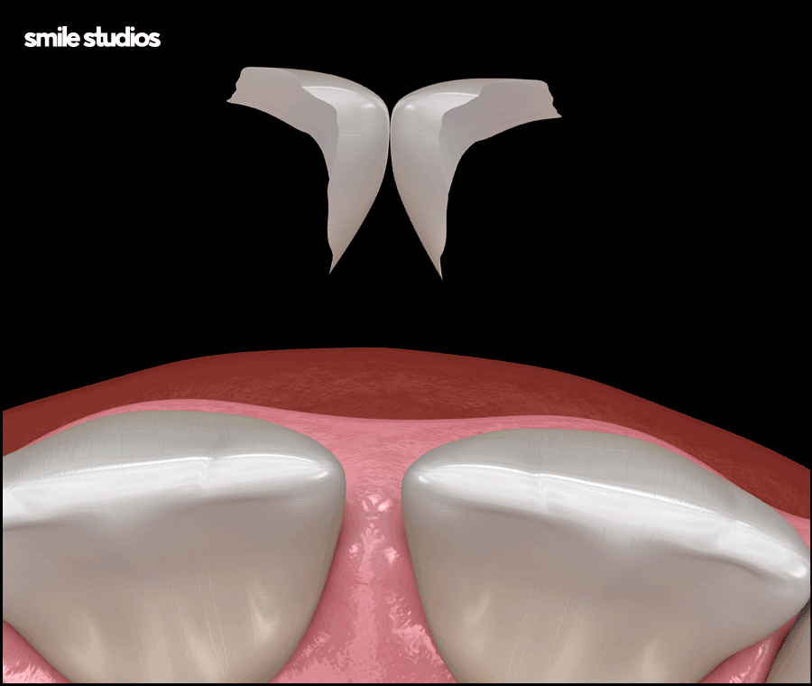 왜소치라미네이트 심미성 개선 효과, 필요성 관련 이미지 6