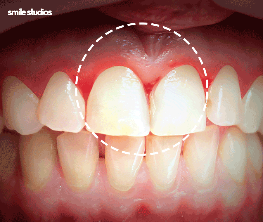 거미스마일 앞니 잇몸 과노출, 원인 및 보완 방법 관련 이미지 5