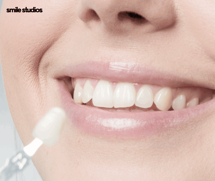 압구정 라미네이트 성공적인 결과를 만드는 핵심은? 관련 이미지 5