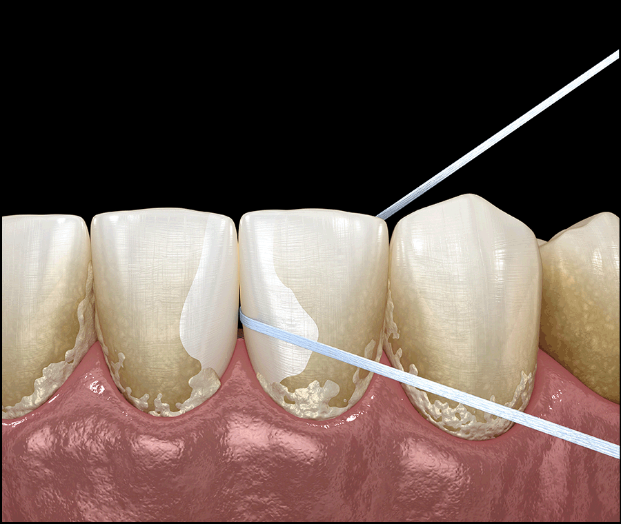 신사동치과 라미네이트 수명 늘리는 방법 A to Z 관련 이미지 5