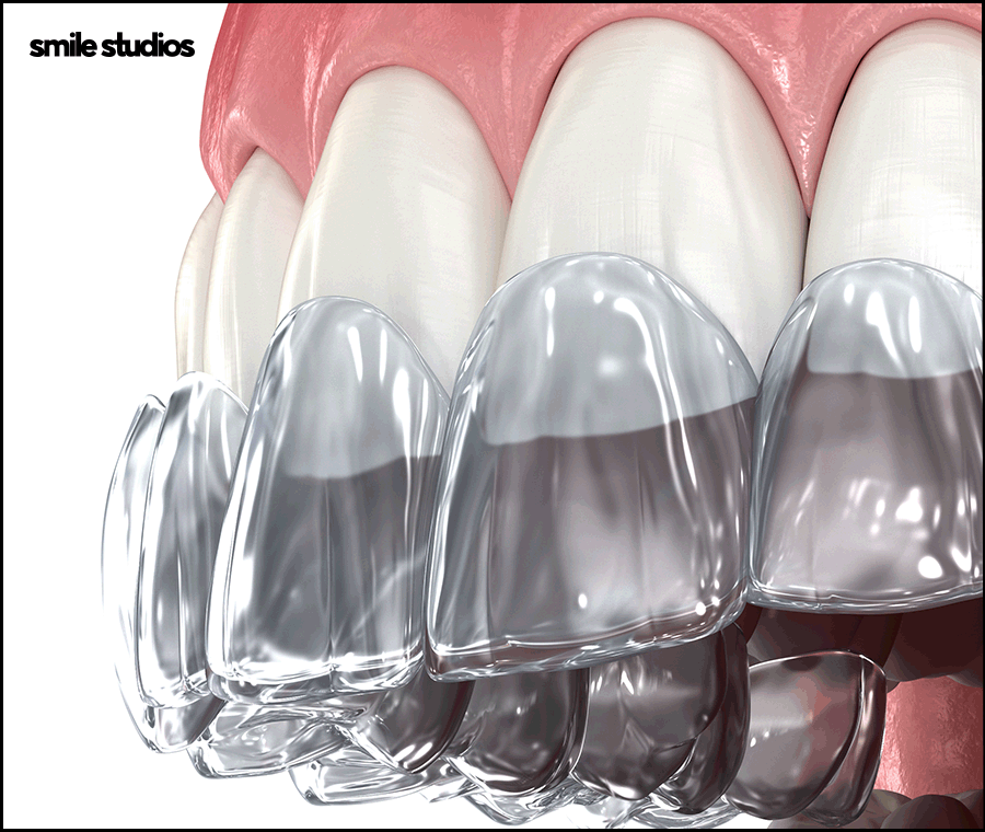 잠원동치과 치아교정 관련 이미지 3