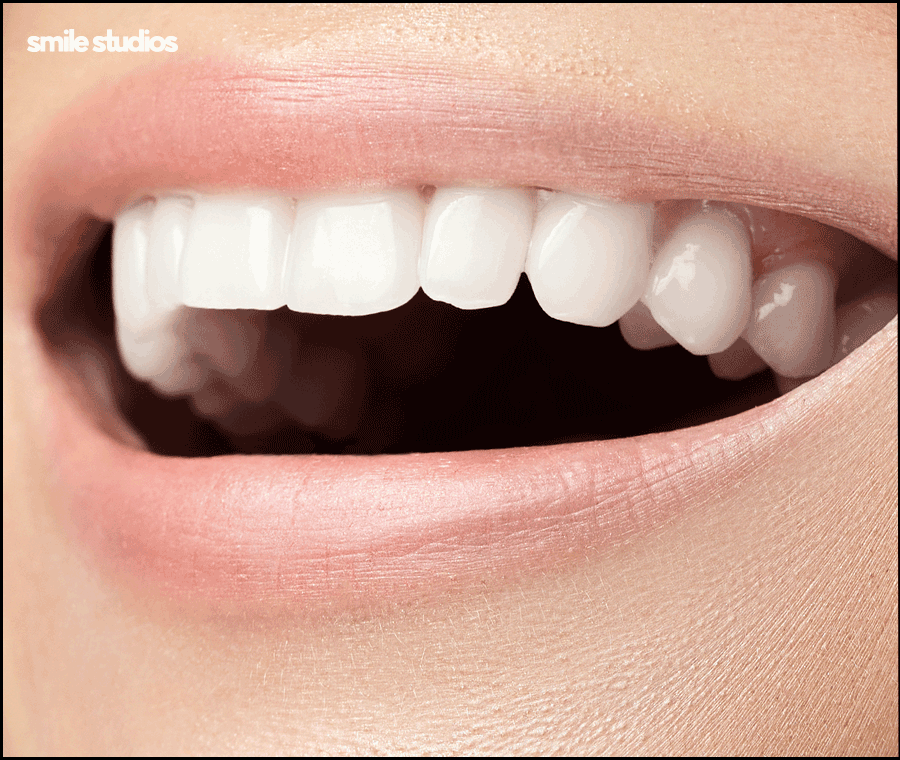 앞니부러짐 치아파절 대처 방법은? ft. 라미네이트 관련 이미지 9