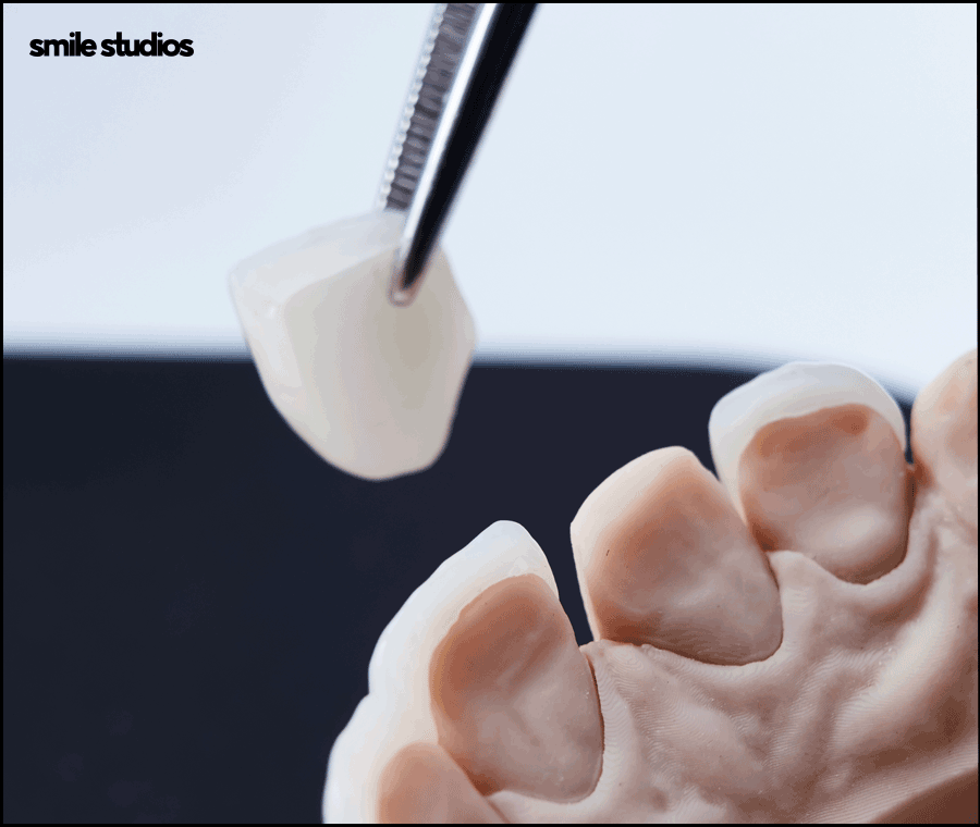 라미네이트 빠짐, 재부착 가능할까요? +대처방법 관련 이미지 5