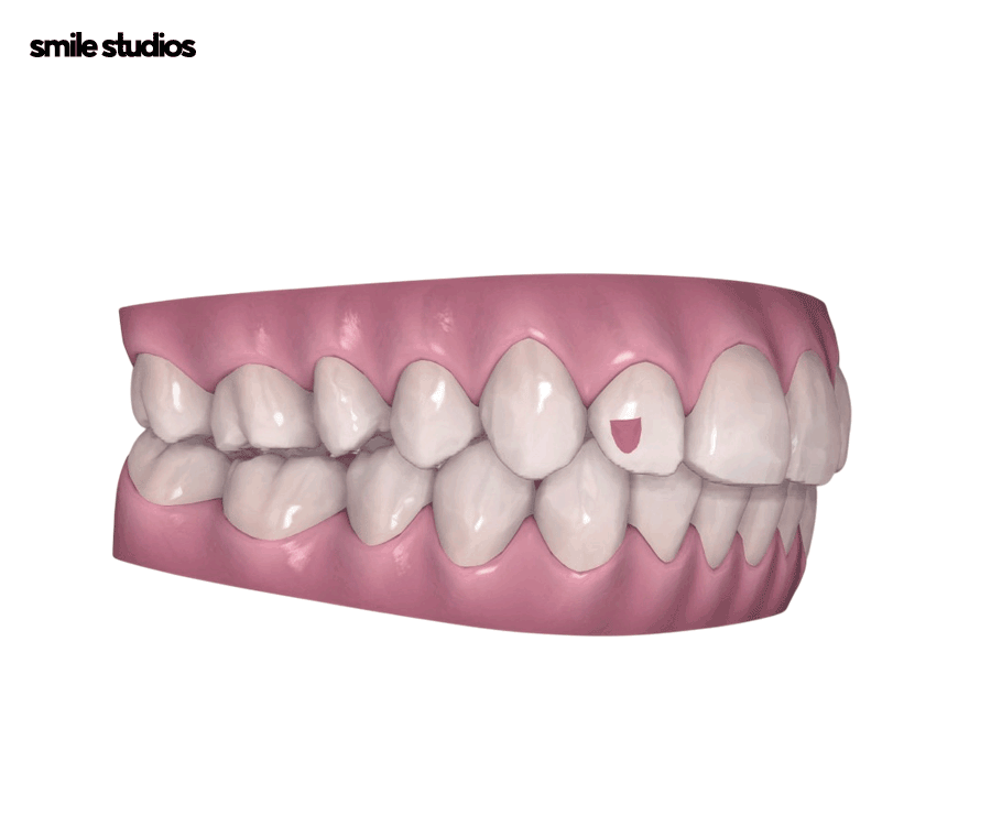 인비절라인 어태치먼트 부착 원리, 탈락 시 대처법 관련 이미지 6