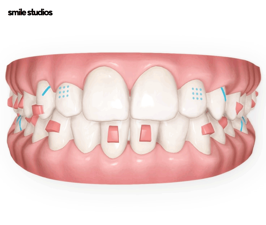 뻐드렁니 교정 성공적인 결과를 위한 key 확인 관련 이미지 5