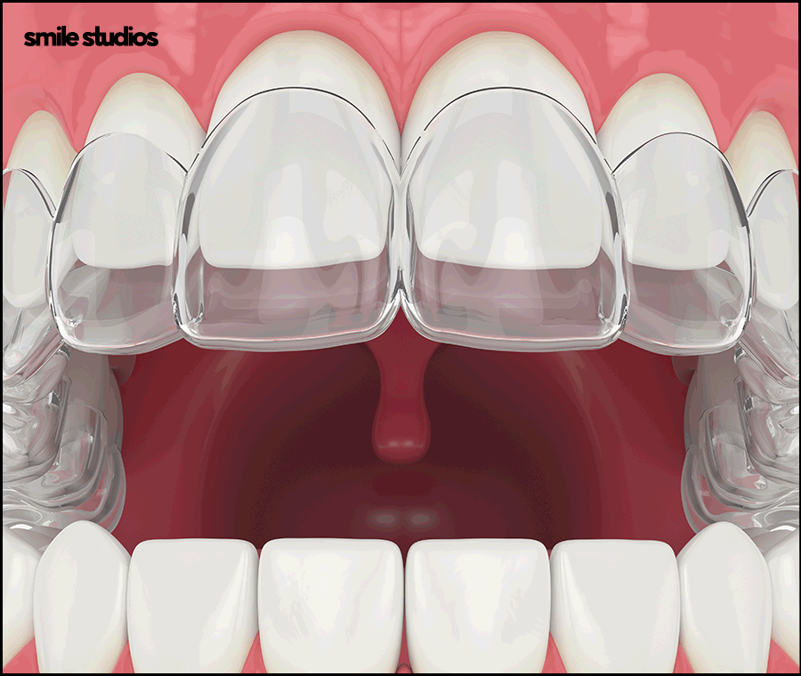 돌출입 인비절라인 기간, 과정, 개선 효과 관련 이미지 5