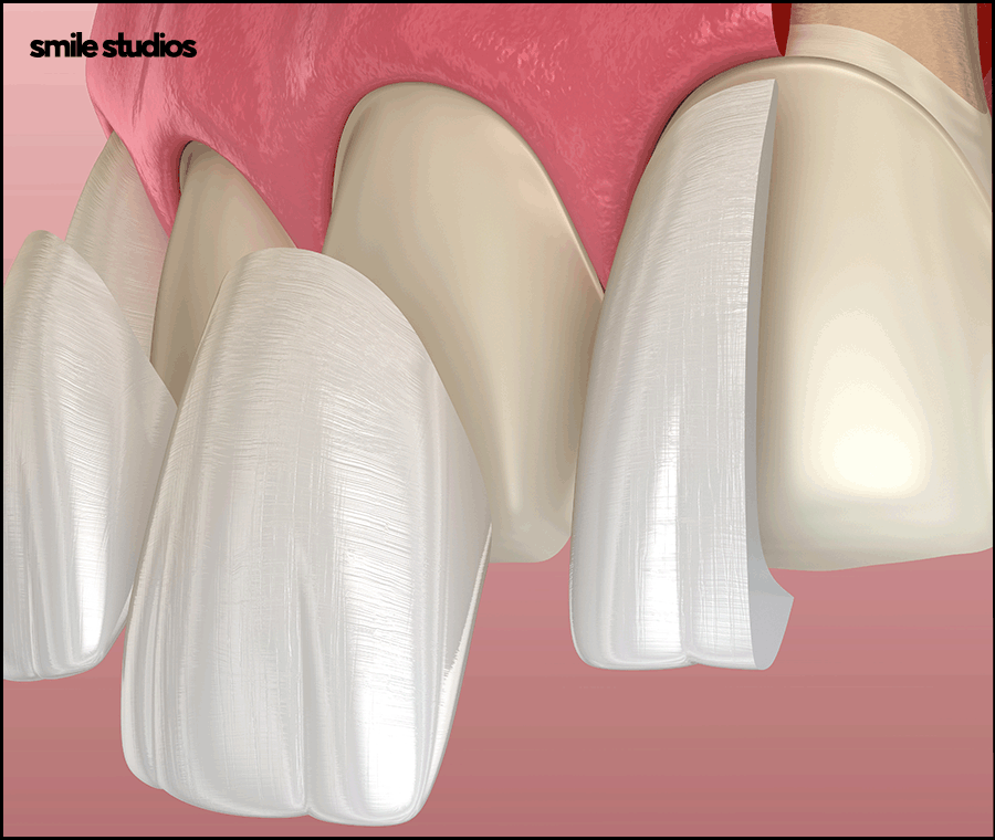 무삭제 라미네이트 효과, 원리, 선호하는 이유 A to Z 관련 이미지 6
