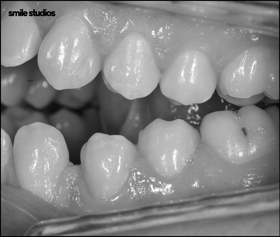 잠원동치과 치아교정 관련 이미지 10