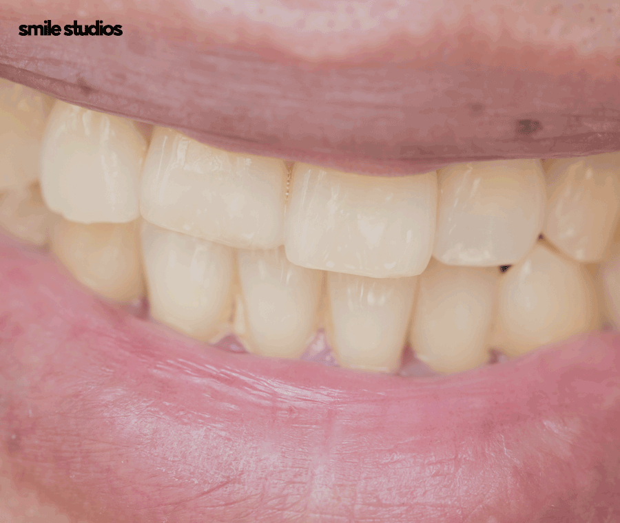 학동역치과 라미네이트 고민된다면 사전에 확인할 점 관련 이미지 2