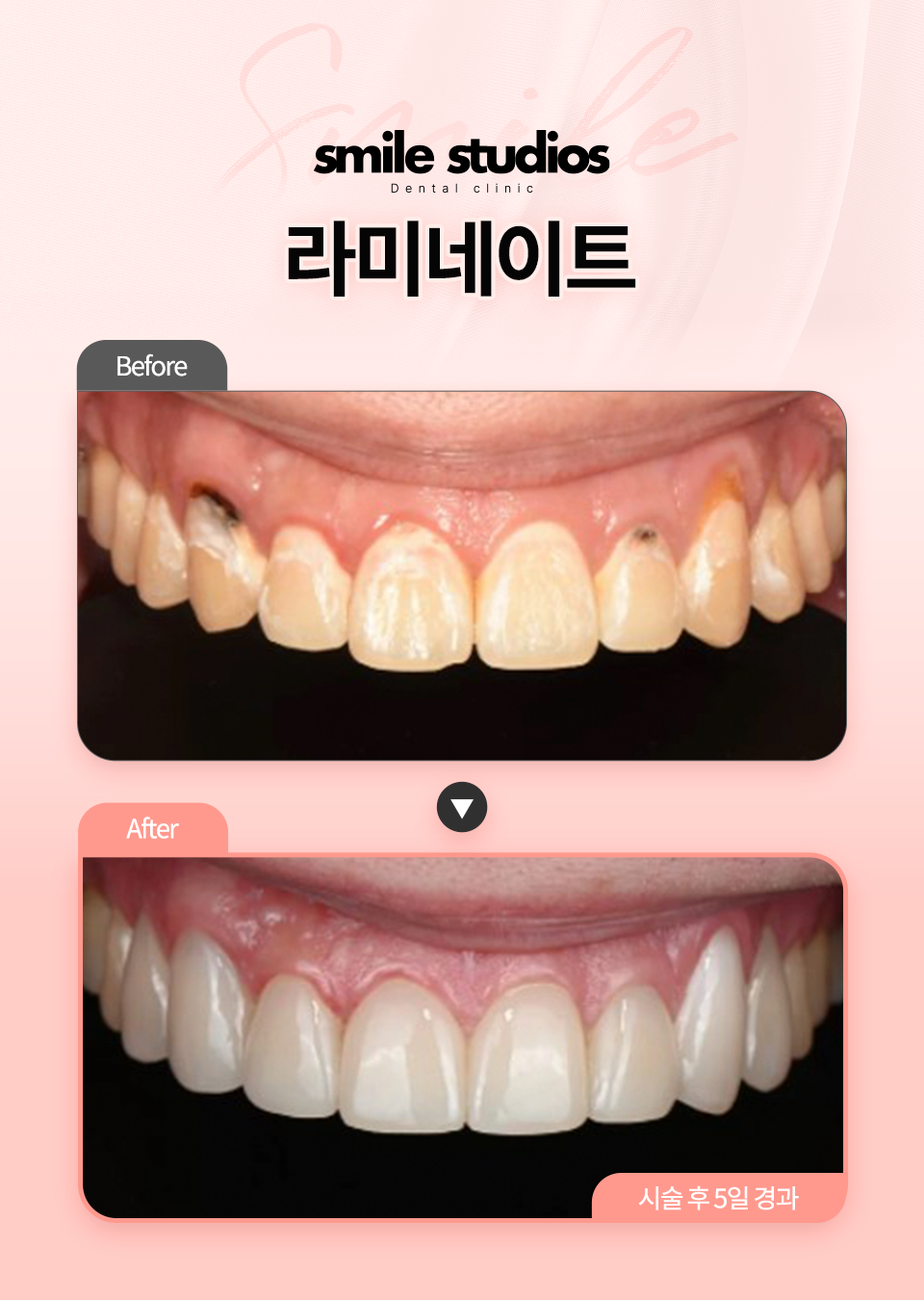 서울라미네이트, 후회 없는 선택 위한 결정적 차이! 관련 이미지 10