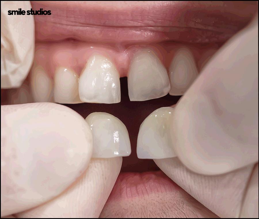 치경부마모증, 주저앉은 잇몸? 원인과 해결 방법 관련 이미지 7