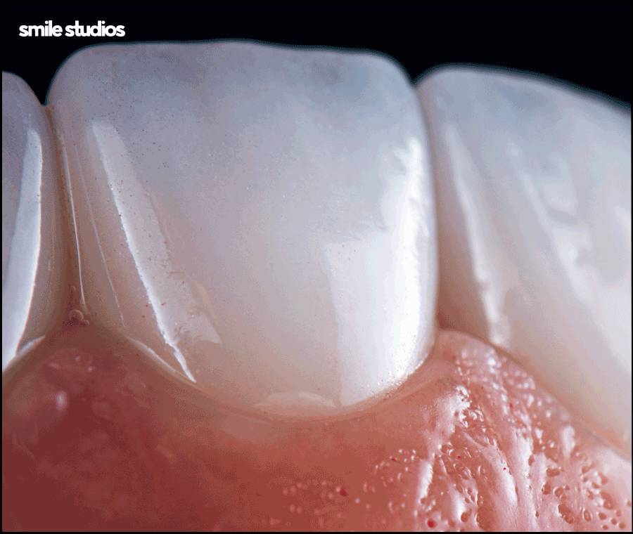 강남무삭제라미네이트 시작 전 확인할 핵심 포인트 관련 이미지 7