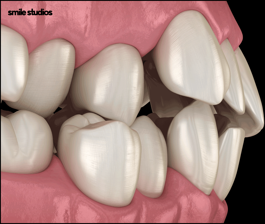 서울인비절라인 권장 케이스, 장점, 치료 시간 정리 관련 이미지 3
