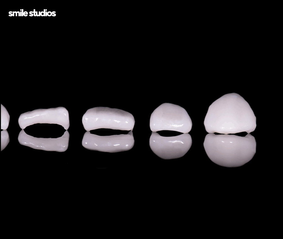 학동역치과 라미네이트 시작 전 확인해야 할 체크사항 관련 이미지 6