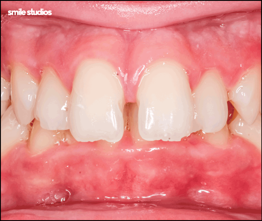 과개교합 교정을 위한 나노라이너 특징 총 정리 관련 이미지 7