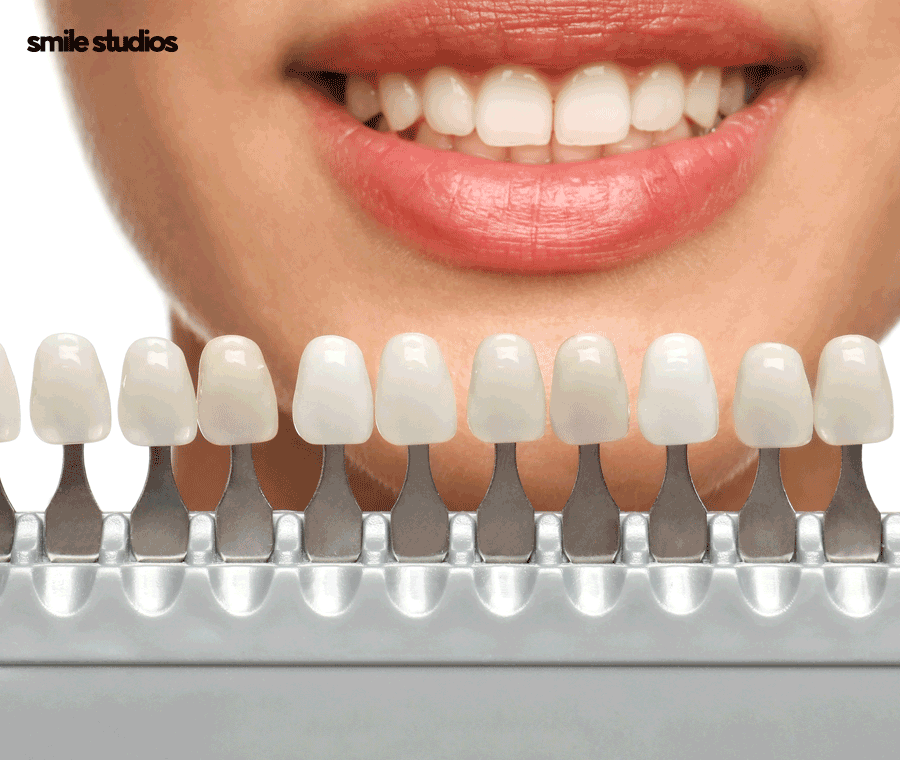 강남 신사역 치과 앞니 벌어짐 교정vs라미네이트 관련 이미지 7