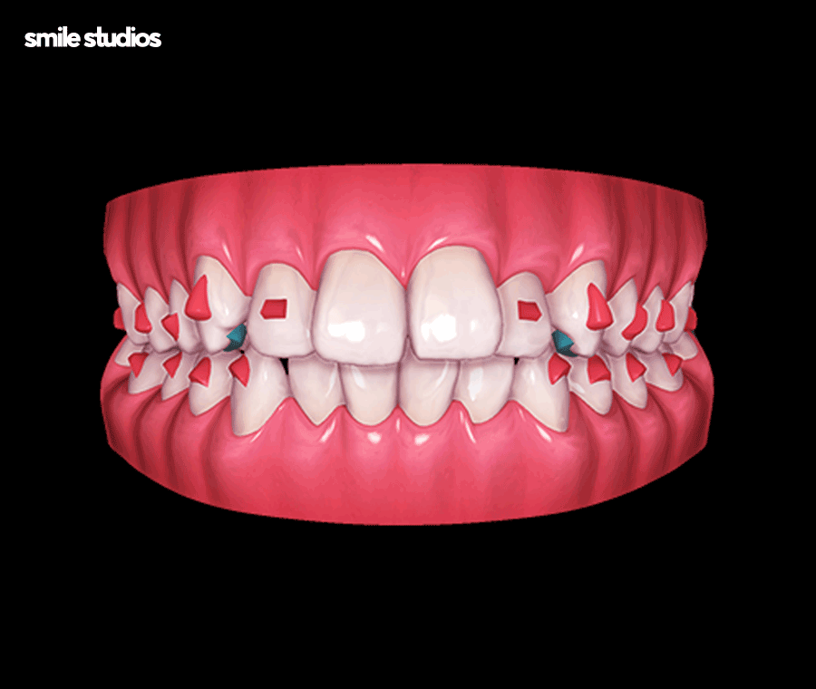 부정교합 교정기(투명) 종류 및 특징 알아보기 관련 이미지 8
