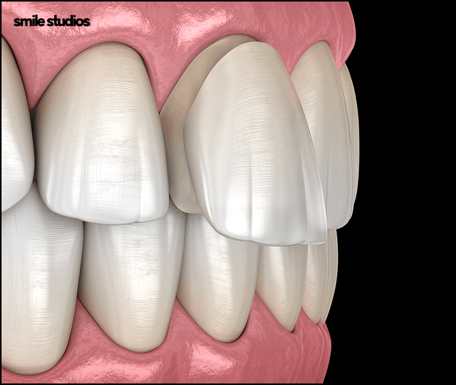 앞니 라미네이트가격 확인 시 같이 체크할 OO은? 관련 이미지 3