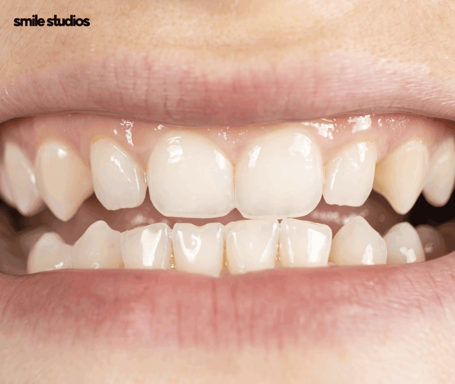 옥니 교정 필요한 이유, 발생 원인, 방법 파헤치기 관련 이미지 5