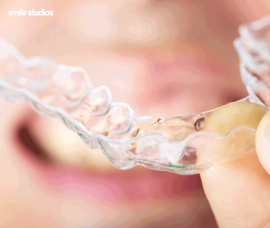 덧니교정 비용보다 중요하게 생각해야 하는 핵심 관련 이미지 8