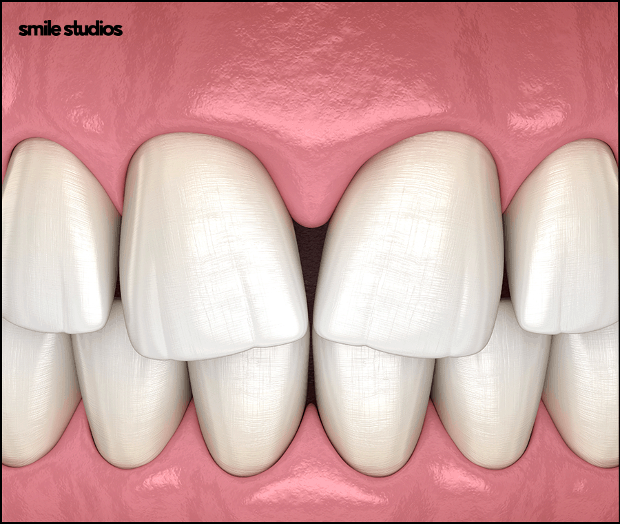 라미네이트 교정 효과를 기대할 수 있는 케이스는? 관련 이미지 4