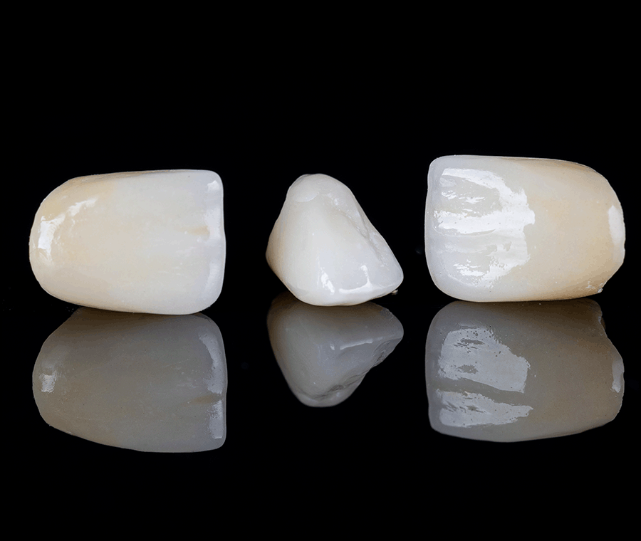 치과라미네이트 고른 치아 만들 때 핵심은? 관련 이미지 3