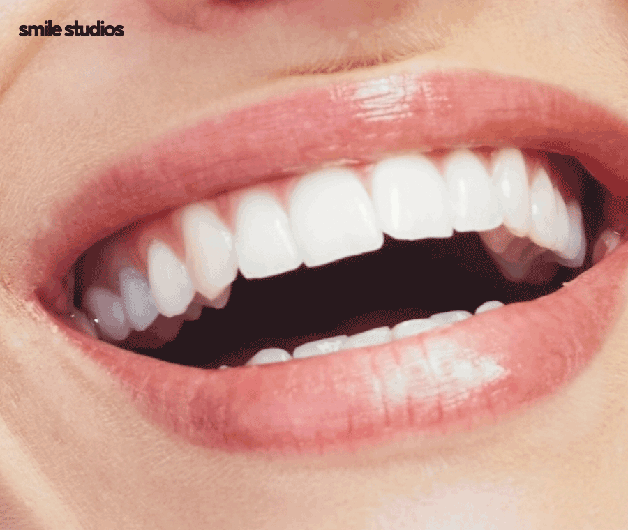 강남역 교정치과 삐뚠 앞니, 부분 치료 괜찮을까? 관련 이미지 9