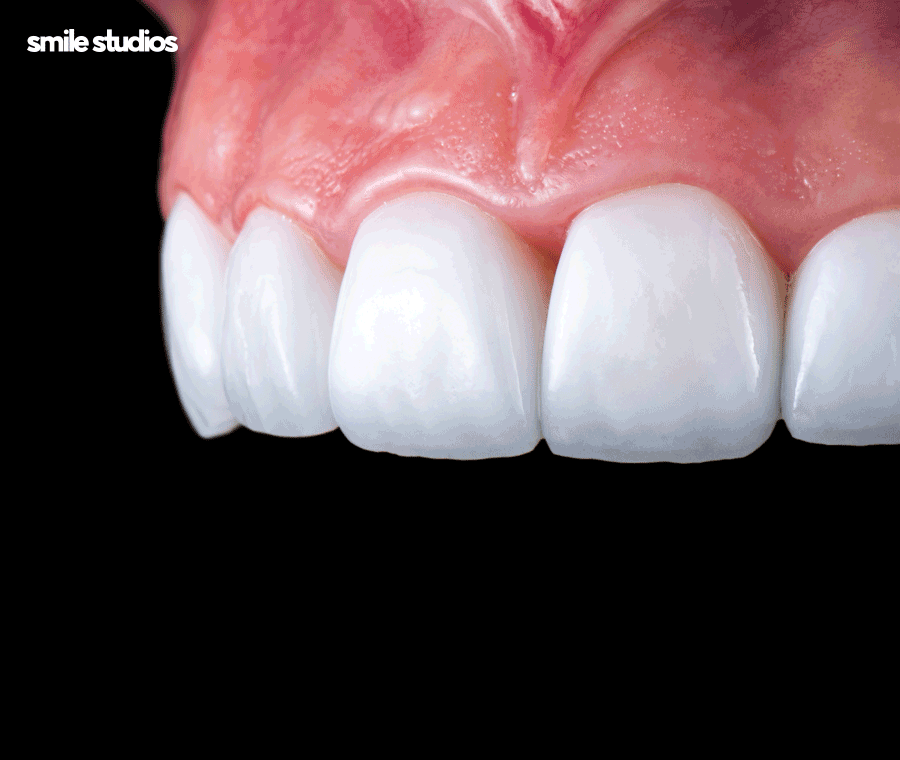 라미네이트 빠짐, 재부착 가능할까요? +대처방법 관련 이미지 7