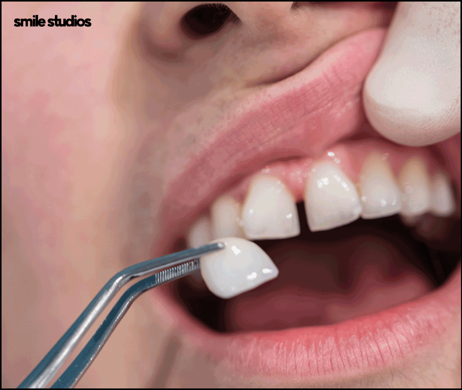 무삭제 라미네이트 효과, 원리, 선호하는 이유 A to Z 관련 이미지 3