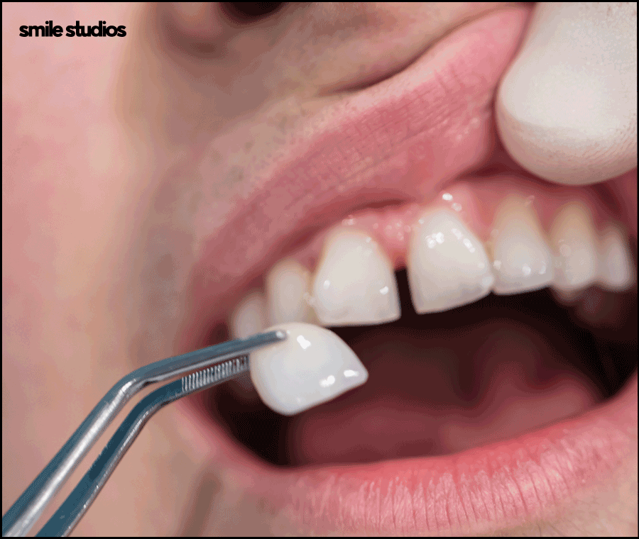 연예인 라미네이트 자연스러운 미소의 비밀은? 관련 이미지 6