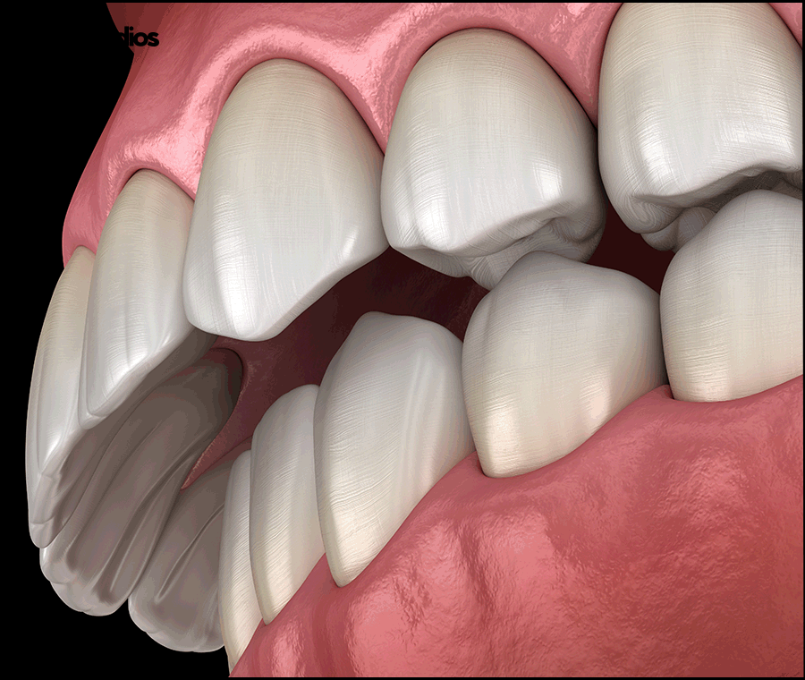 반포동 치과 돌출입 교정, 인비절라인 효과는? 관련 이미지 3