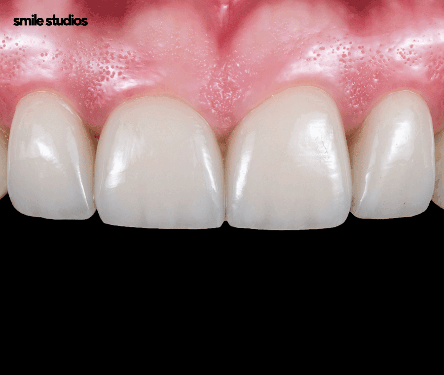 강남역 교정치과 삐뚠 앞니, 부분 치료 괜찮을까? 관련 이미지 10