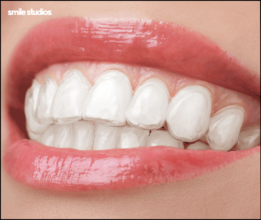 논현동 치과 인비절라인 투명교정 효과, 장/단점 관련 이미지 3