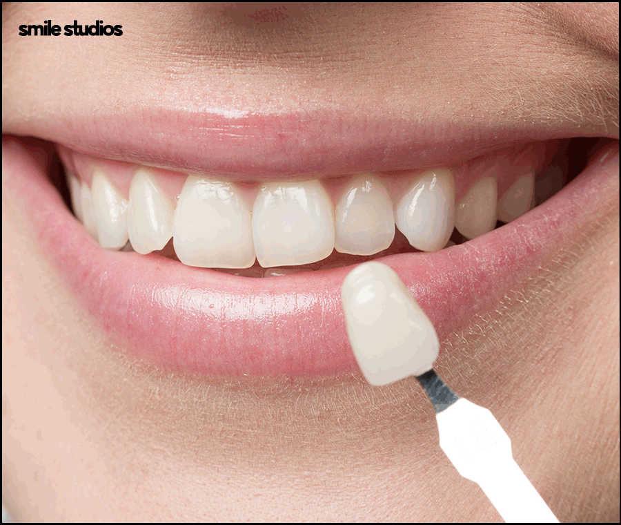 라미네이트 교정 효과를 기대할 수 있는 케이스는? 관련 이미지 10