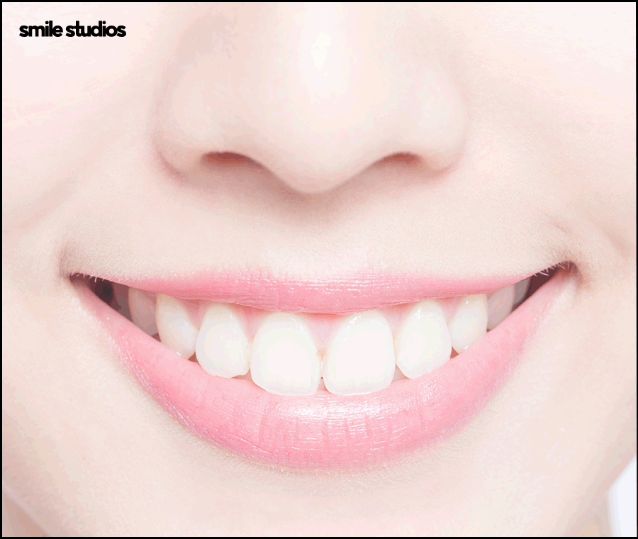 역삼역 치과, 치아 파임 증상 라미네이트 효과는? 관련 이미지 9
