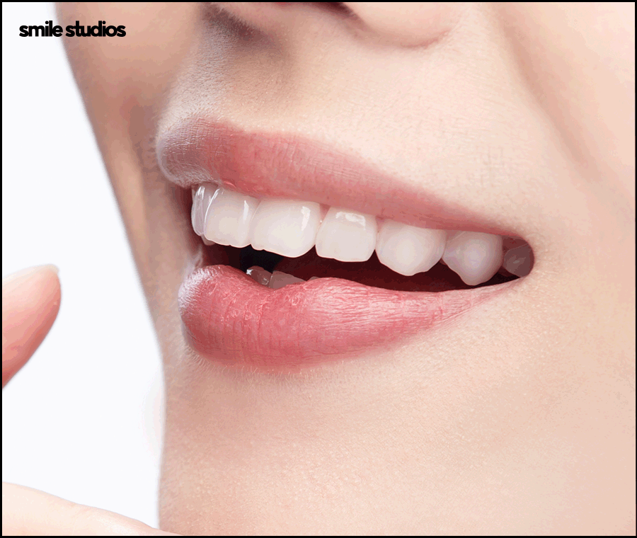 연예인라미네이트 선호도가 높은 이유, 효과 관련 이미지 2