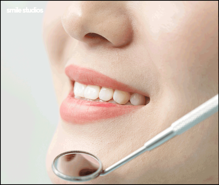 학동역치과 라미네이트 시작 전 확인해야 할 체크사항 관련 이미지 4