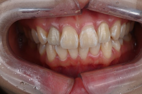 신사역치과 라미네이트 후 이미지 변화? 자연스러움의 비밀 공개! 관련 이미지 4