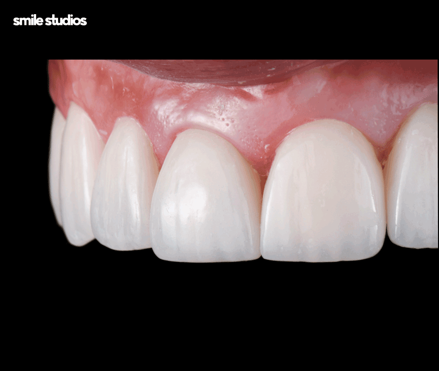 학동역치과 라미네이트 시작 전 확인해야 할 체크사항 관련 이미지 3